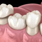 dental crown aftercare, dental crown maintenance, dental crown care, post-procedure dental crown care, dental health tips