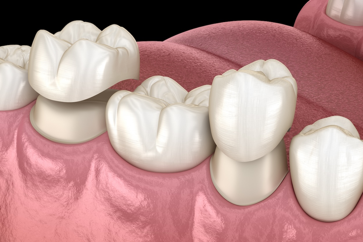 dental crown aftercare, dental crown maintenance, dental crown care, post-procedure dental crown care, dental health tips