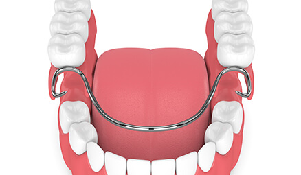 illustration of a set of partial dentures