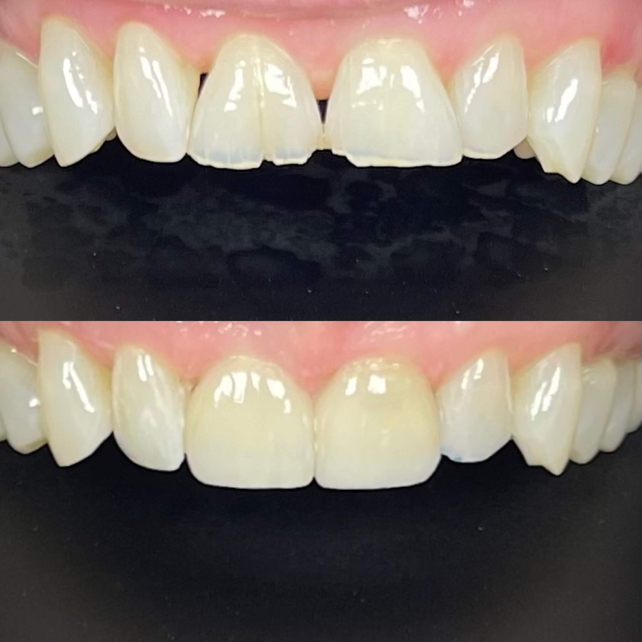 before and after dental veneers