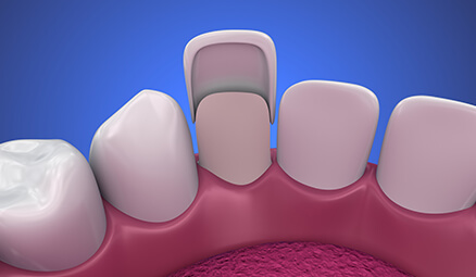 illustration of a dental veneer