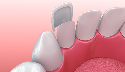 illustration of a dental veneer