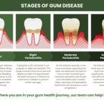 stages of gum disease infographic