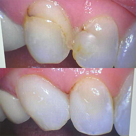 before and after fillings