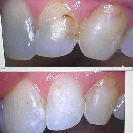 before and after fillings