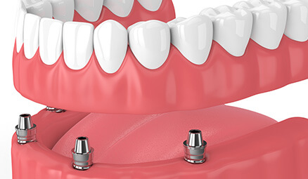 illustration of implant-supported dentures