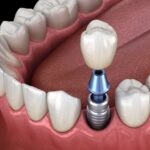 dental implants, dental implant on a premolar