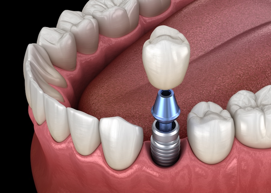 dental implants, dental implant on a premolar