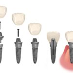 parts of a dental implant for the dental implant process