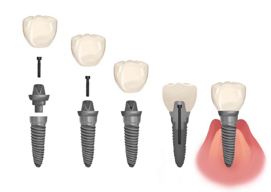 parts of a dental implant for the dental implant process