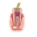 root canal treatment